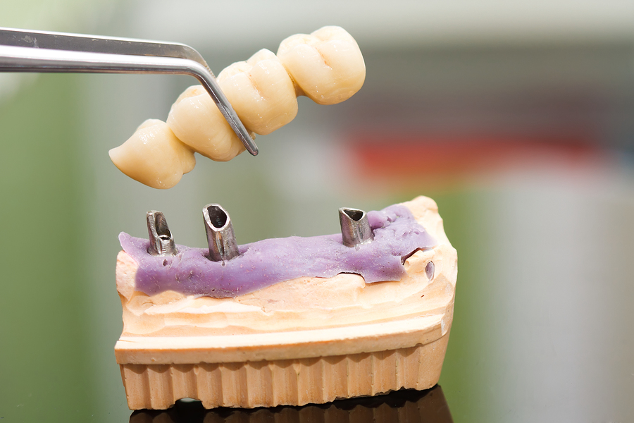 dental implants mesa az